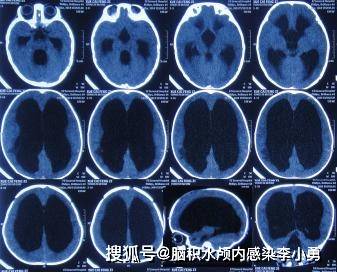 合并先天脊髓栓系和脊膜膨出的婴儿巨大脑室性脑积水脑室腹腔分流术后