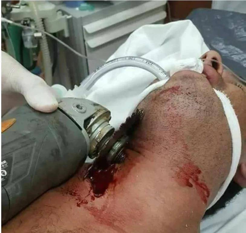 惨烈!近日某员工使用角磨机切割物件,不慎脱手弹飞