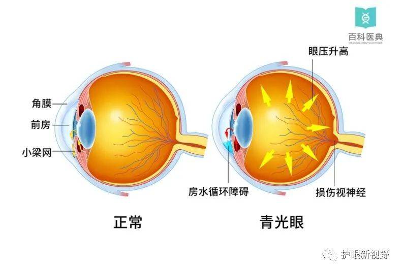 若不加以治療,青光眼最終會導致失明?