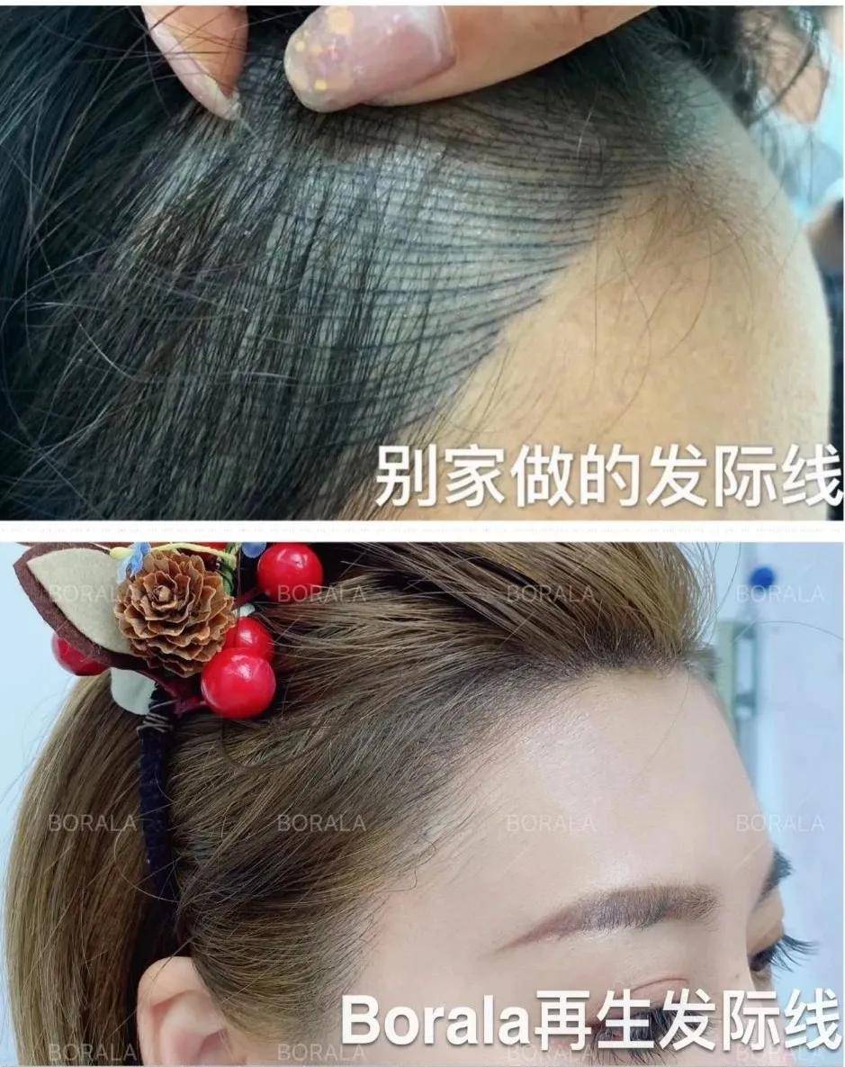 技能|别再问了！柏芮拉再生发逆龄术不是纹发，更不是植发！