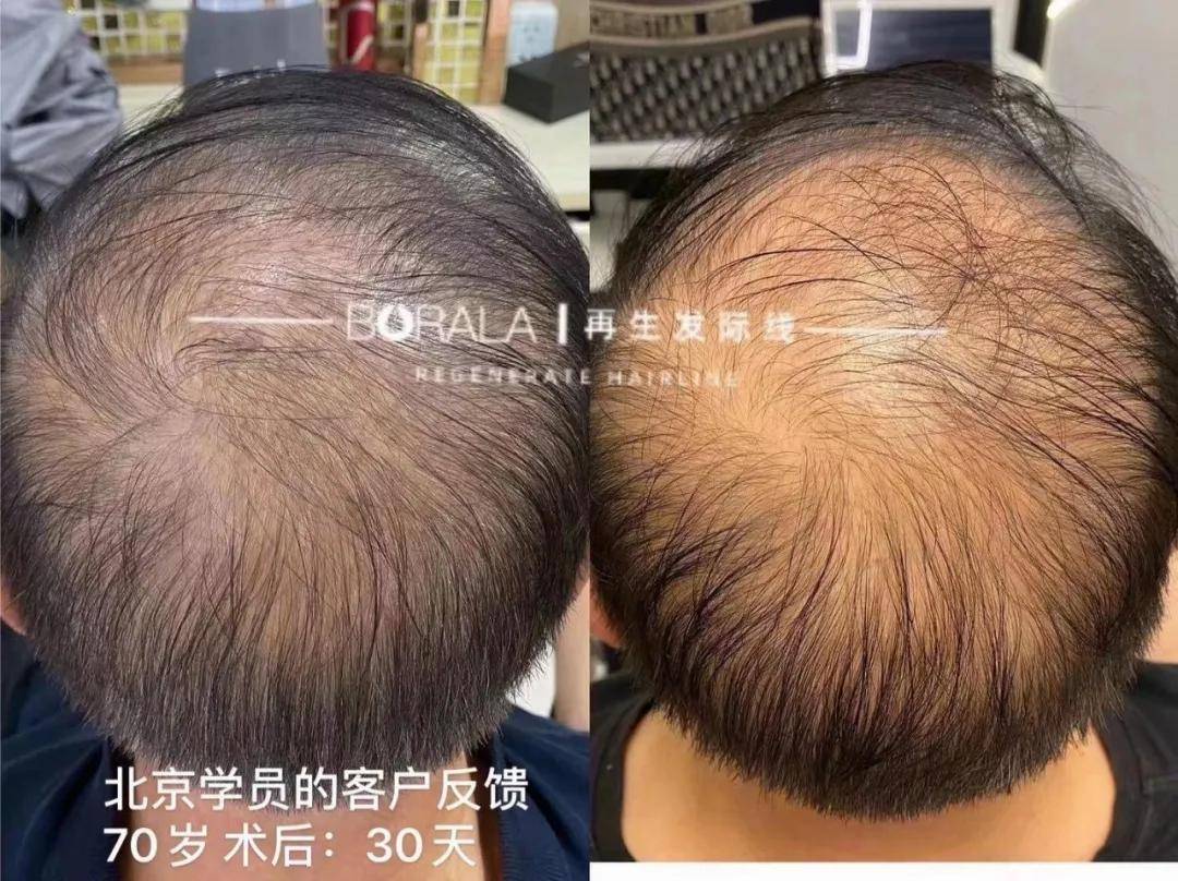 技能|别再问了！柏芮拉再生发逆龄术不是纹发，更不是植发！
