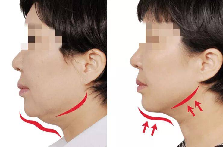 拉皮手术对比照片拉皮手术能维持多久几年震惊全场