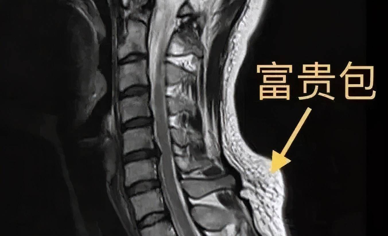 困扰女明星的富贵包竟是夺命包?