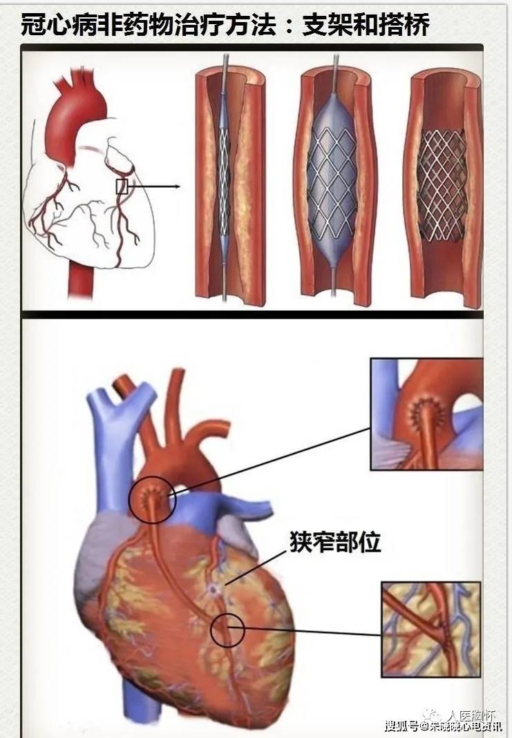 心脏支架图片原理图片