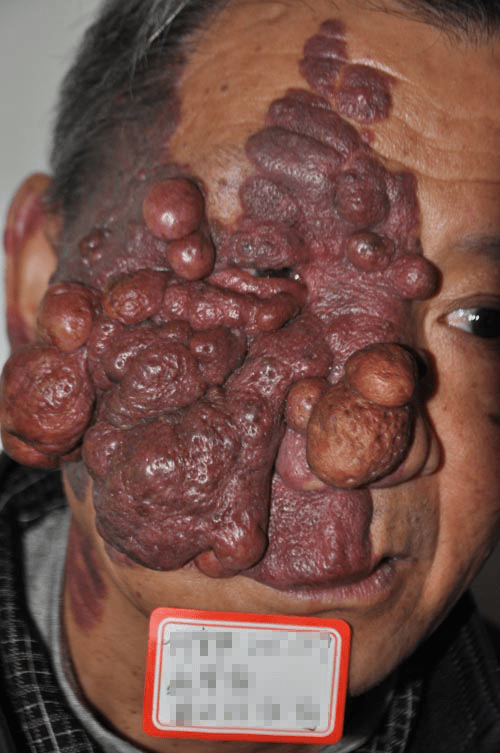 上海长江胎记医院:救助 一例罕见的重度红胎记患者