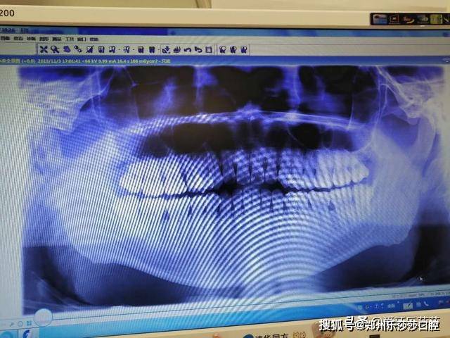 從我的ct上看,我的智齒還是蠻大的,比前面的大牙大一圈.