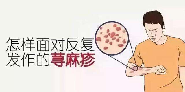 什麼是蕁麻疹得了蕁麻疹需要注意哪些