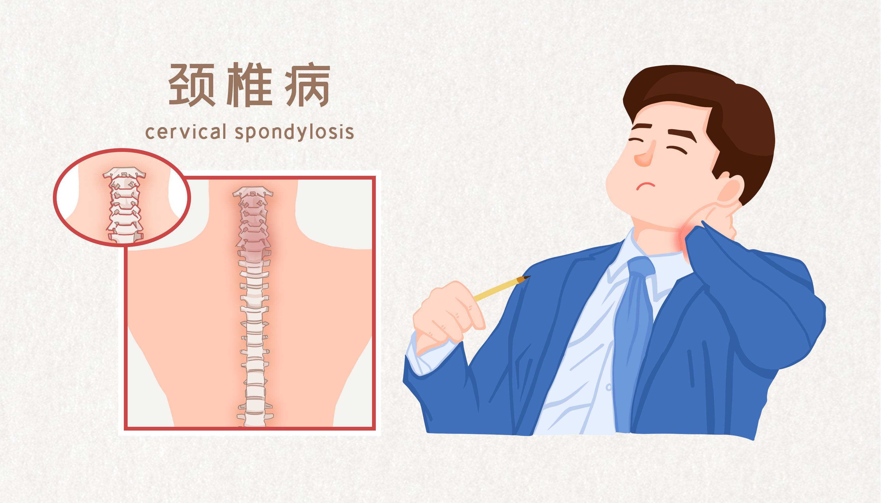 2,頭暈摔跤:由於頸椎增生壓迫血管造成供血障礙所致,是頸椎病發病的