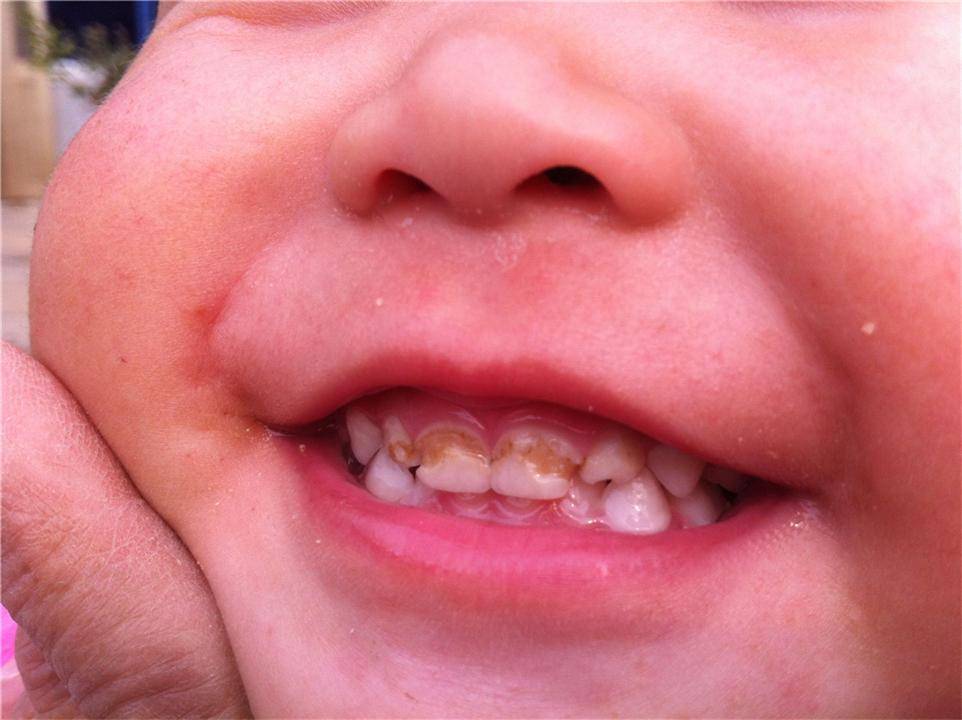 小朋友牙齿坏了的照片图片
