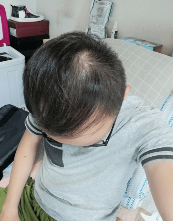 28岁男子脱发4年头顶发量非常稀疏寻求有效的生发方法