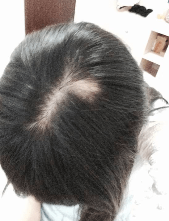 下个月就结婚结果未婚妻却出现斑秃有没有快速长出头发的方法