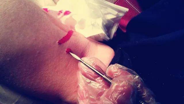 中医刺血疗法对一切以痛为主的病症有特效