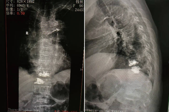 治疗|杭州城东医院案例丨90岁高龄椎体压缩性骨折新技术—?经皮穿刺椎体后凸成形术