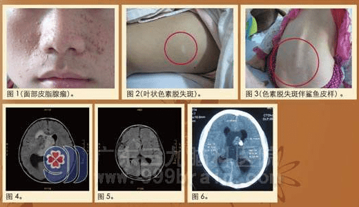 结节性硬化会遗传吗