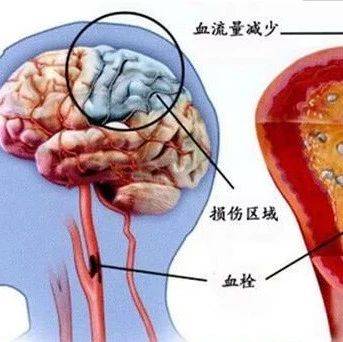 脑梗都是拖出来的?这6个症状医生一直在提醒!_手机搜狐网