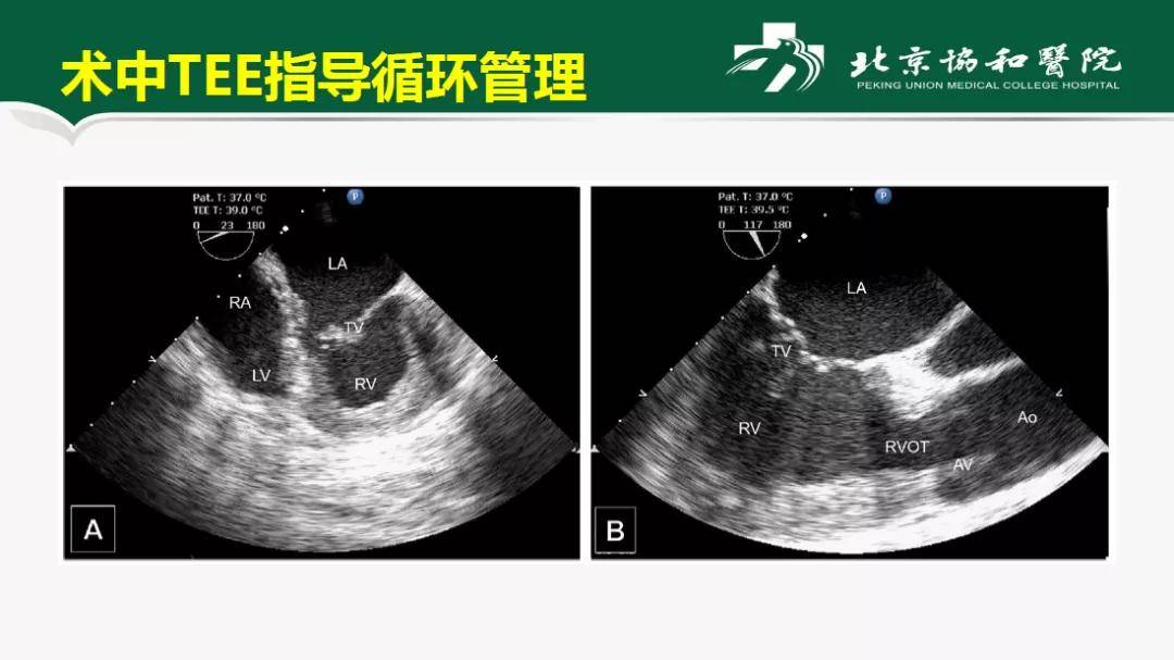 嗜鉻細胞瘤和副神經節瘤ppgl切除手術的麻醉管理