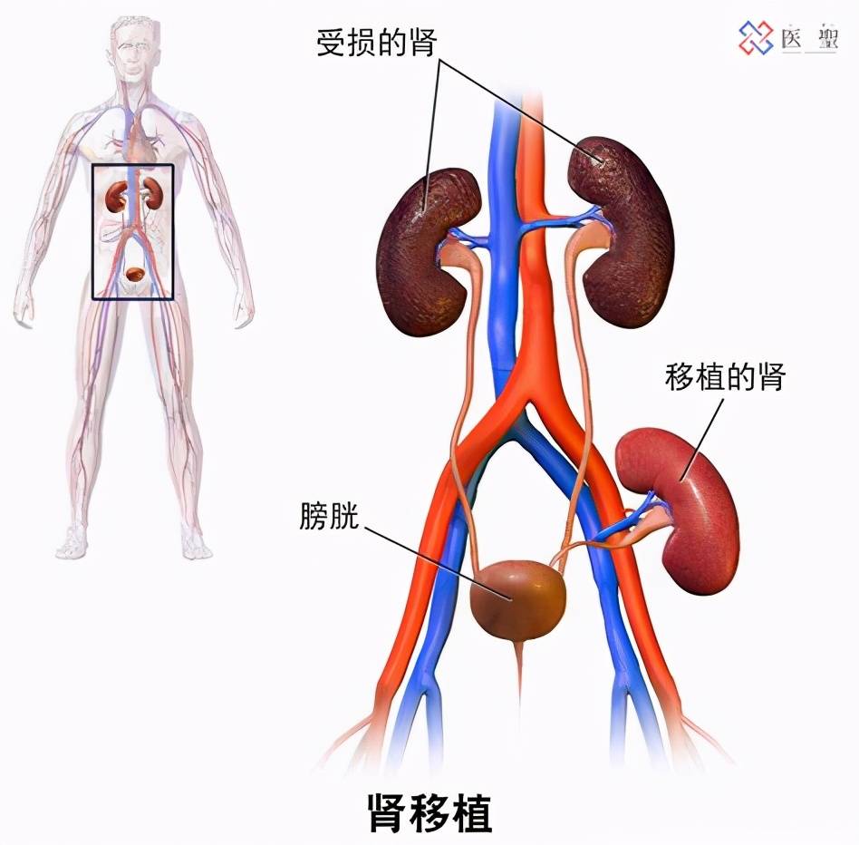 再生医疗 | 干细胞治疗慢性肾脏病 改善肾功能