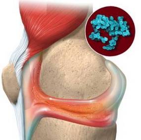 【科普】真菌性关节炎