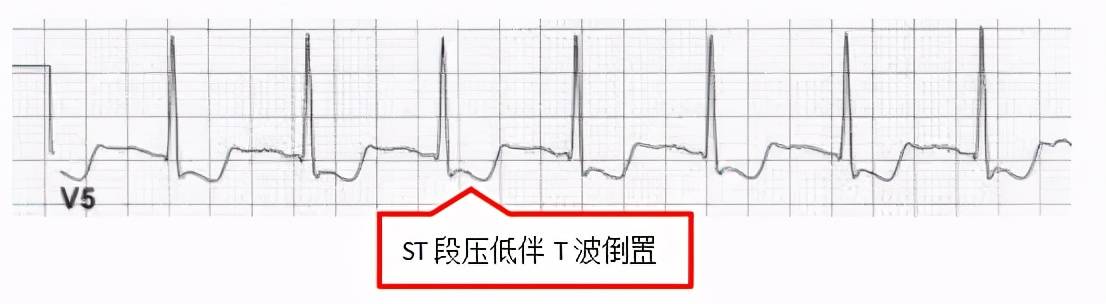 的导联st段压低和(或)缺血型t波倒置,心绞痛缓解后,心电图可恢复正常