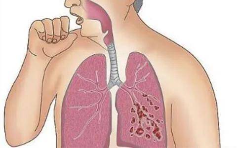 哮喘与慢性支气管炎的区别是什么?家有哮喘患者怎样正确护理?
