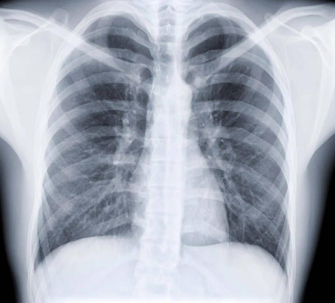 吸烟的肺部x光片图片