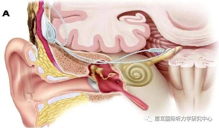 聽神經瘤患者保留聽力切除後如何進行聽力干預濟南助聽器