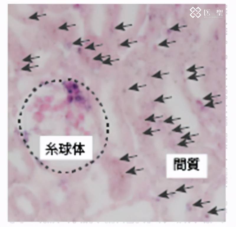 红细胞|ISEI日本干细胞—脂肪由来间充质干细胞治疗急性肾炎