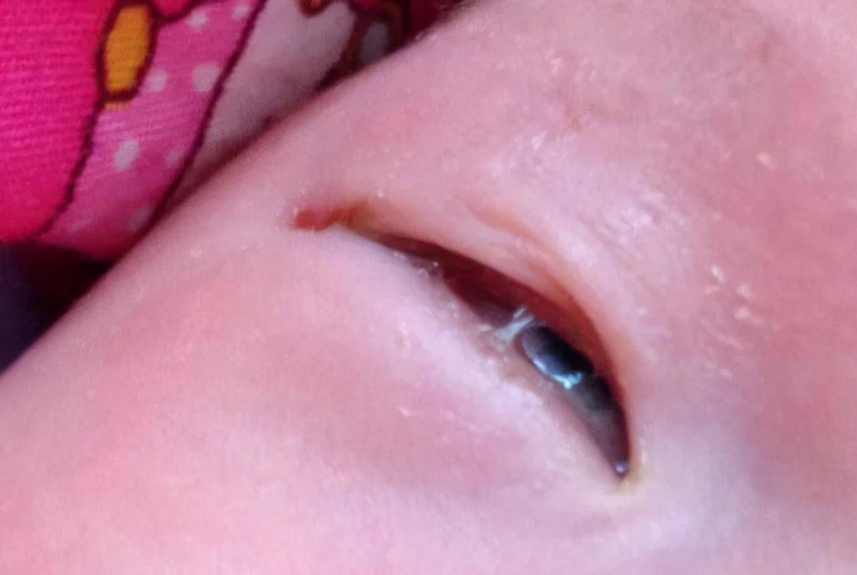 婴儿眼睛白色分泌物图图片