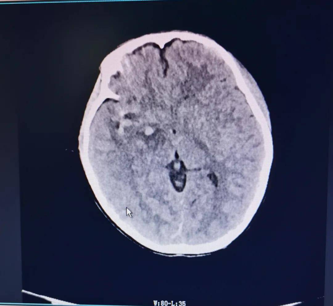 贵州松桃县9岁女童车祸伤致深度昏迷,历经生死考验后站起来了