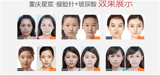600块钱的瘦脸针可靠吗(瘦脸针600多块钱怎么样)