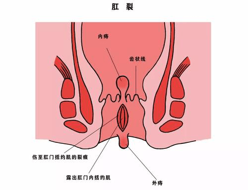肛裂的位置的图片图片