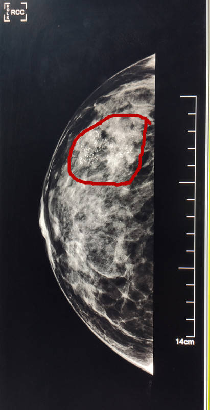 咸阳首例自体背阔肌皮瓣全乳房再造术诞生记