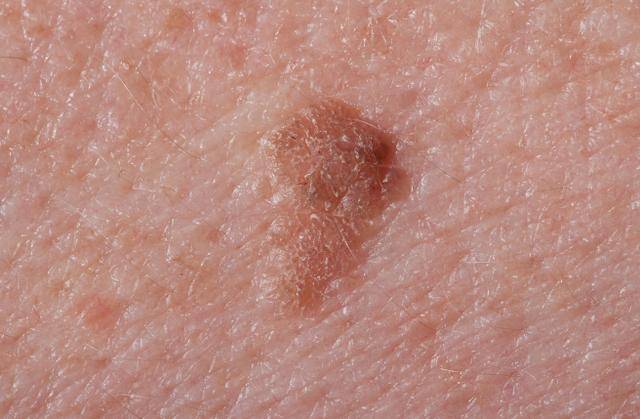 颜色多为粉红色的菜花状,很轻易就会剥落,其实这就是尖锐湿疣,如果