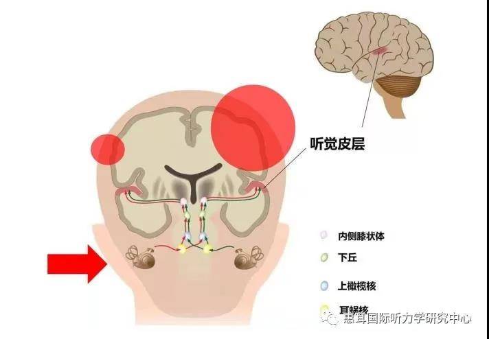 單側人工耳蝸植入後如果對側沒有驗配助聽器或植入耳蝸,對聽覺功能有