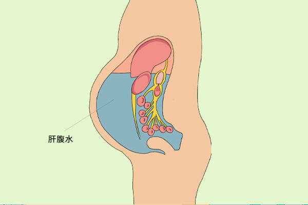 肝腹水很危险没症状身体早有信号发出要尽早应对