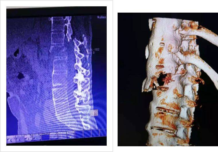 ct, mri(核磁共振)提示:第一腰椎椎体,椎板,棘突骨折并明显移位,脊髓