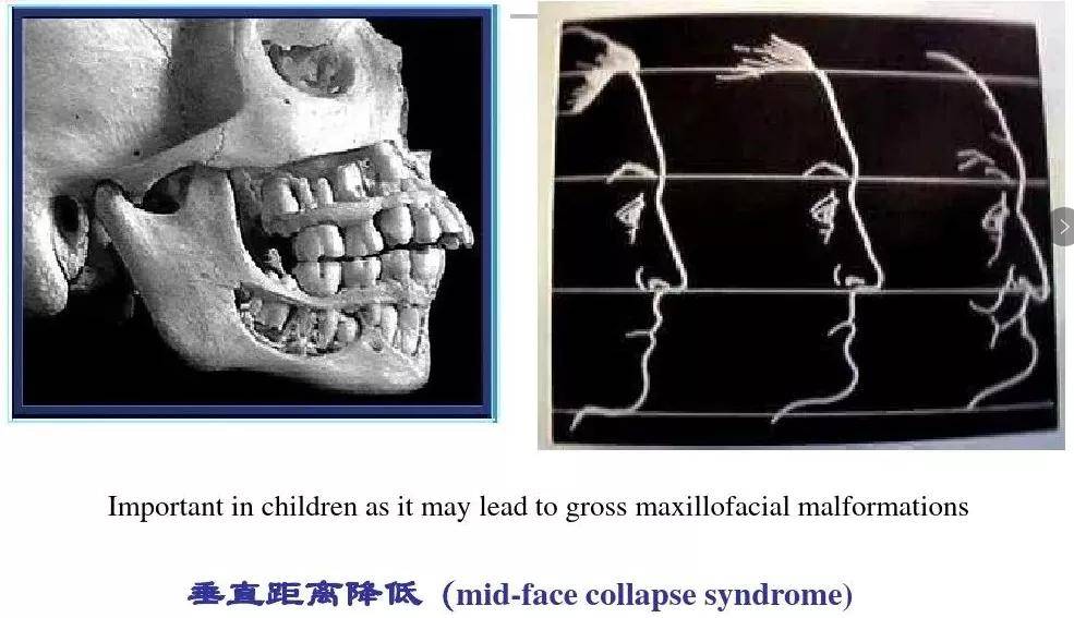 頸背肌肉痛肌痛及觸壓痛頜面肌--咀嚼肌過分疲勞牙槽骨增生牙周炎症