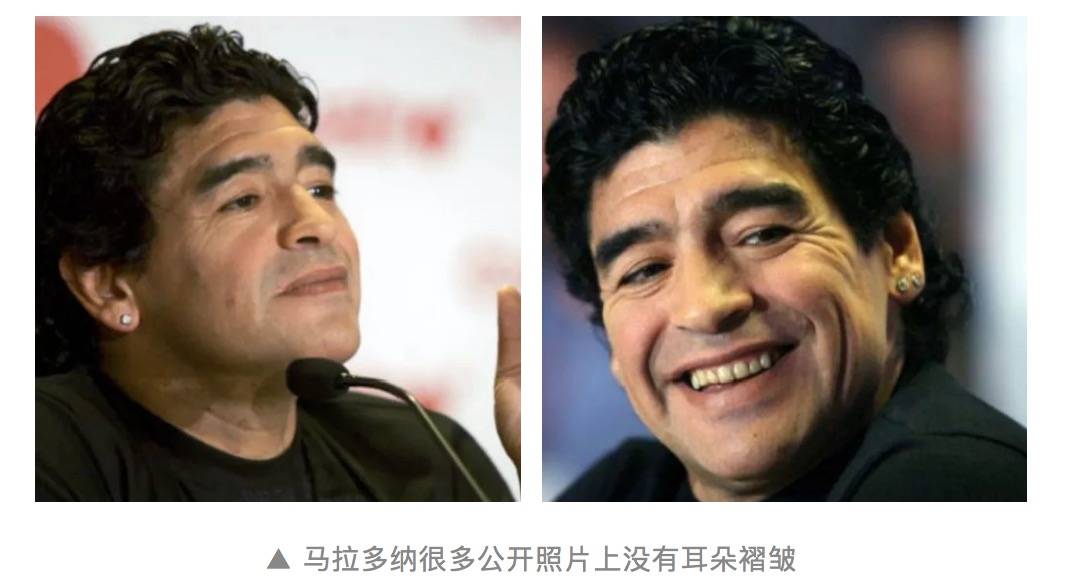 耳朵褶皱是冠心病迹象符合这5点的人心脏更危险