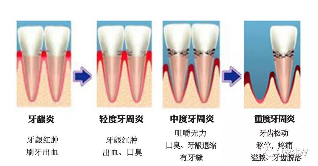 2,牙周炎引起的牙痛