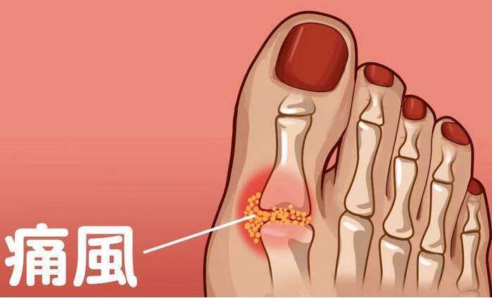别找了,能根治痛风的人,只有你自己