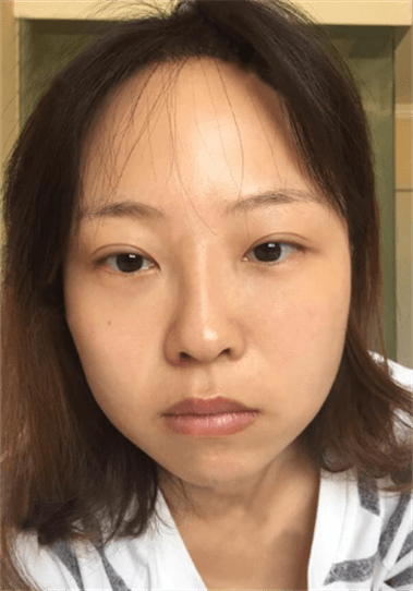 脸太瘦怎么长肉 0bfc44842ff3497389c43c5f9872e82f.png