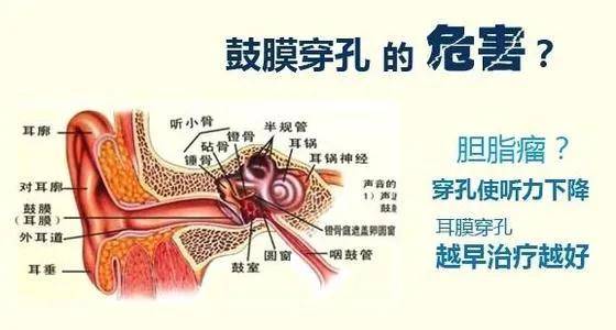 鼓膜穿孔危害不小，请及早就医！搜狐大视野搜狐新闻