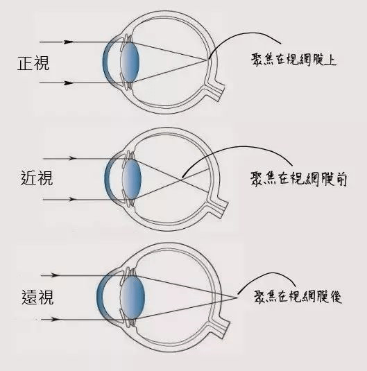 远视眼依据屈光程度不同分为低度远视(300度以内,中度远视(300度至
