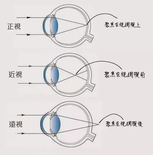 远视眼是怎么回事图片