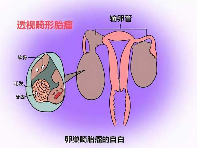 畸胎瘤症状图片