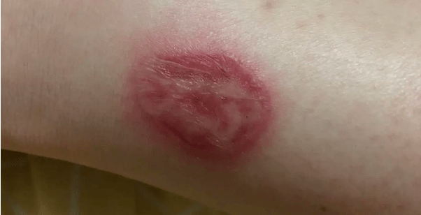 低温烫伤有多可怕不要抱着热水袋睡觉了