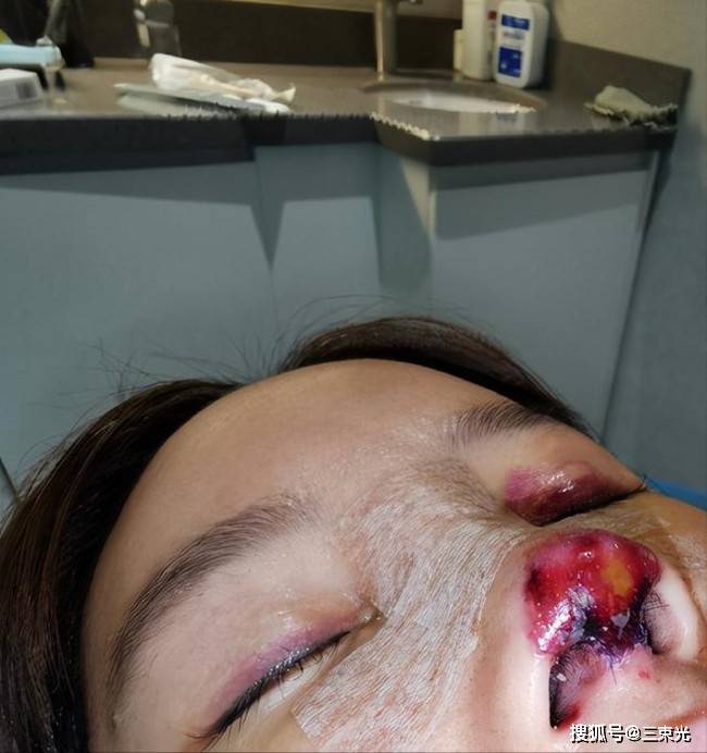 虽然高溜面临毁容,但是高溜还是大方选择公布出来.