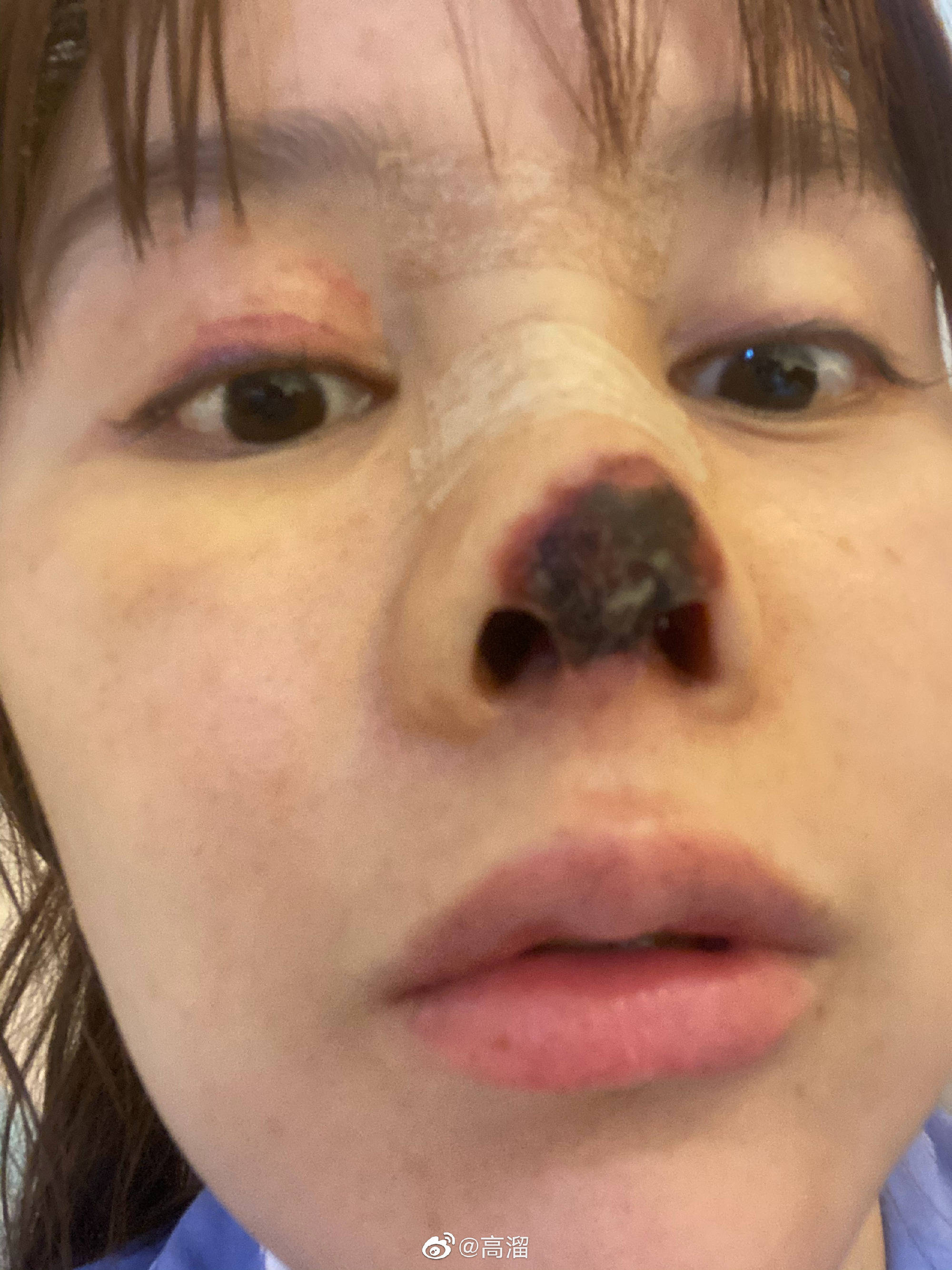 演员高溜整容失败鼻尖坏死
