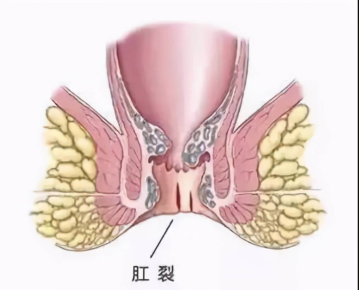 肛裂多见于青中年人,绝大多数位于肛管的后正中线上.