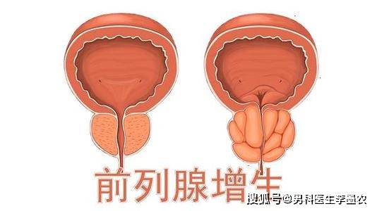 前列腺肥大的自我检测(图1)